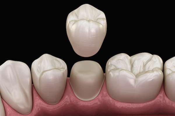 What To Ask Your General Dentist When Preparing for a Crown from King Dentistry in Turlock, CA