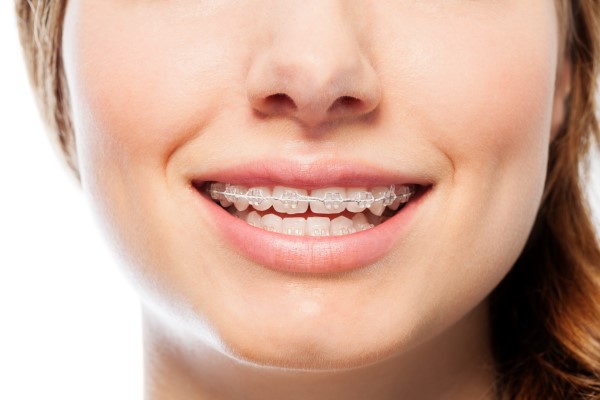 Clear Braces For Aesthetic Results