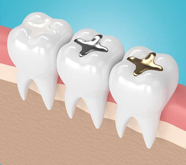 Turlock Composite Fillings