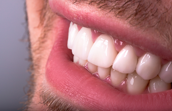 Understanding Dental Crowns Versus Veneers