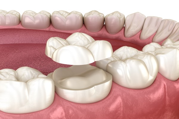 What To Expect When Getting A Dental Crown