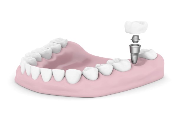 Dental Implants Turlock, CA