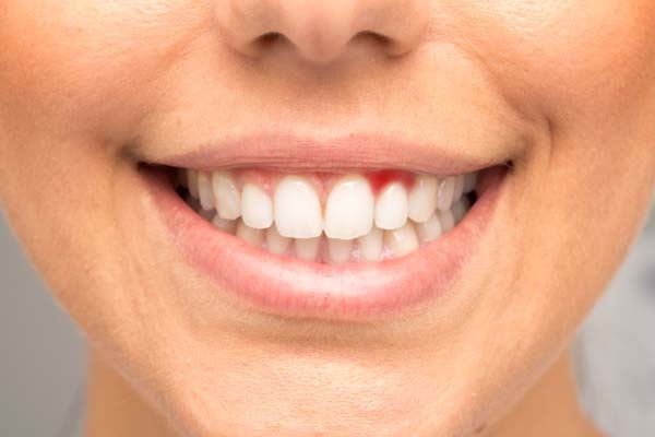 When Is Gum Disease Treatment Necessary?