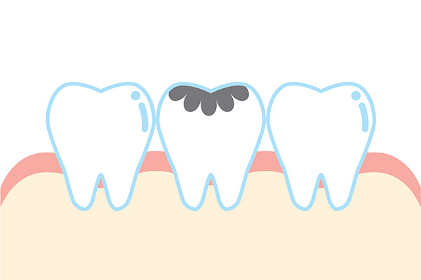 Dental Practice FAQs: How Are Cavities Treated? from King Dentistry in Turlock, CA