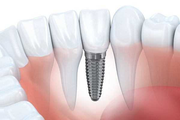 An Implant Is A New Tooth Root Option For Replacing A Missing Tooth