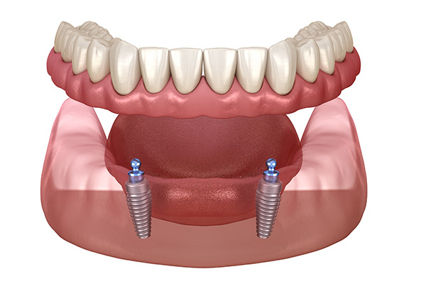 Implant Overdenture Options for Replacing Missing Teeth from King Dentistry in Turlock, CA