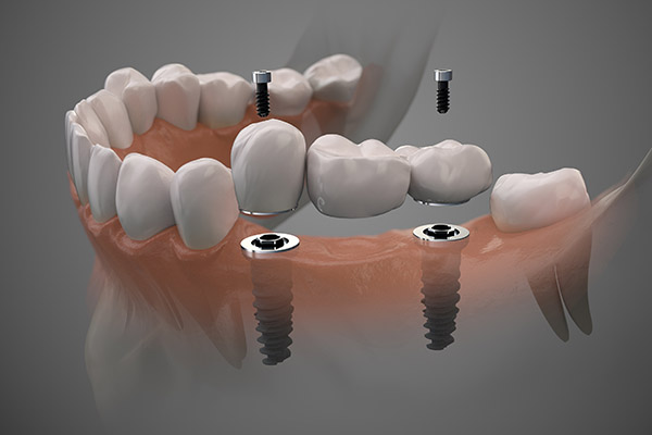 Implant Supported Full Bridge &#    ; An Option For Replacing Missing Teeth