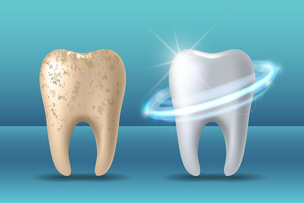 Pros and Cons of Teeth Whitening Treatments from King Dentistry in Turlock, CA