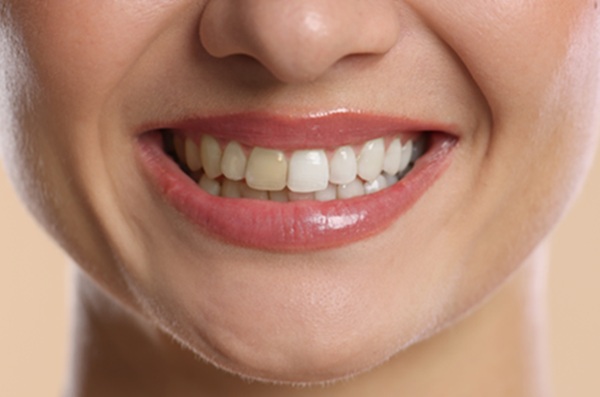 A Beginner’s Guide To Professional Teeth Whitening At Home Treatment